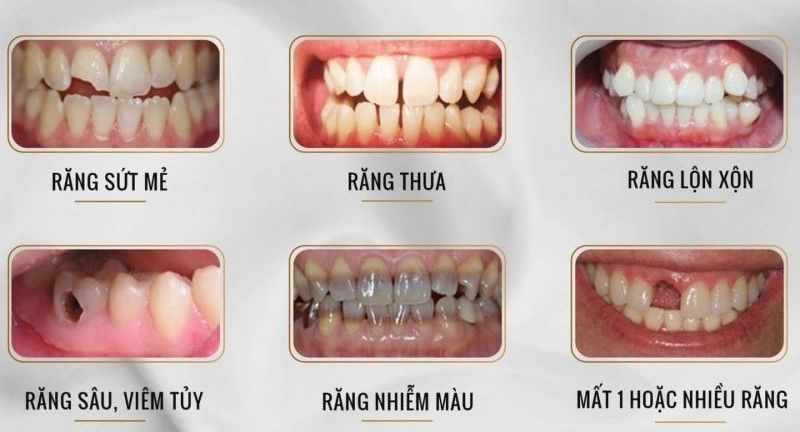 Trường hợp nào nên bọc răng sứ thẩm mỹ Bình Chánh?