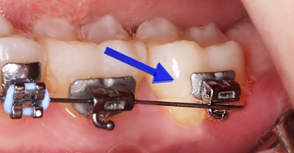 Các vấn đề thường gặp khi sử dụng dây cung niềng răng
