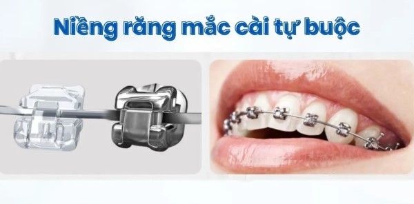 Niềng răng mắc cài kim loại tự khóa