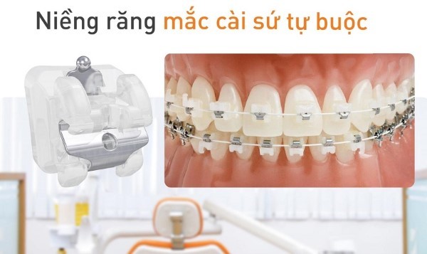 Niềng răng mắc cài sứ tự khóa