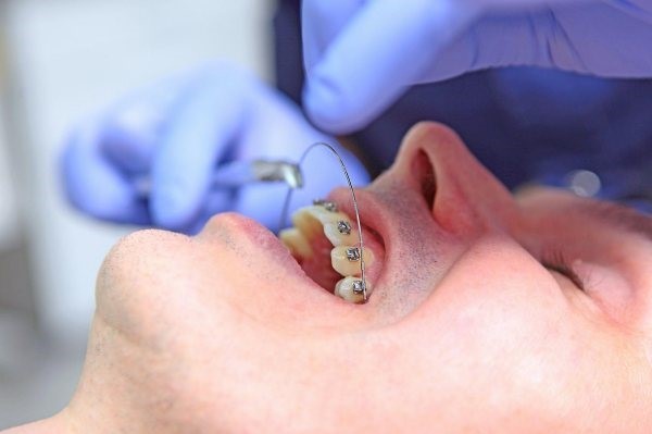 Thay dây cung niềng răng là một phần không thể thiếu