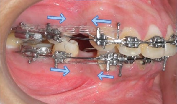 Tác dụng của dây cung niềng răng giai đoạn đầu san đều răng