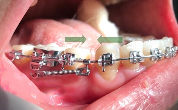 Tác dụng của dây cung niềng răng giai đoạn kéo khít răng