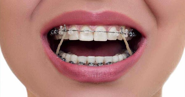 Tác dụng của dây cung niềng răng giai đoạn nắn chỉnh khớp cắn và duy trì