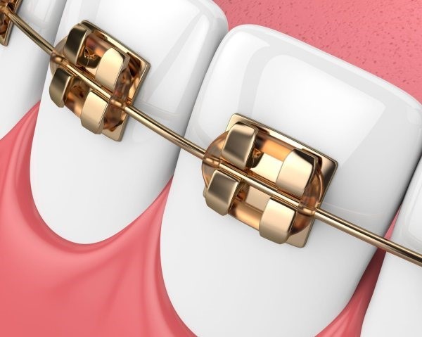 Dây cung niềng răng hợp kim kim loại quý