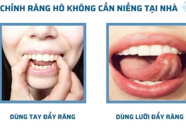 Phương pháp nắn chỉnh răng không cần niềng