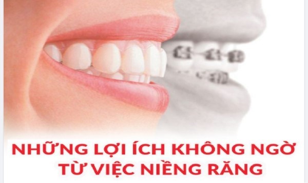 Lợi ích của việc niềng răng khểnh