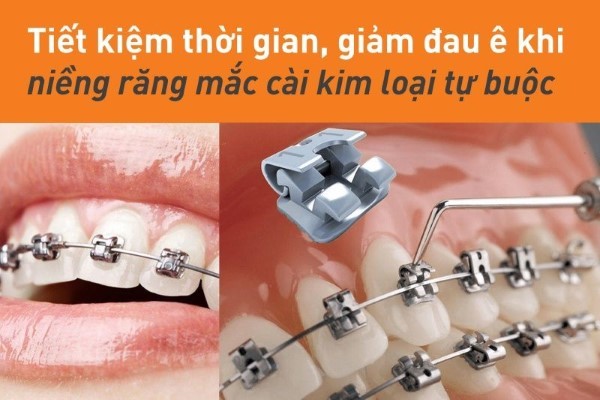 Niềng răng mắc cài tự động