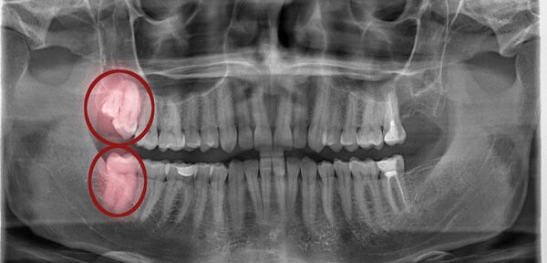 Răng khôn mọc kẹt về phía gần