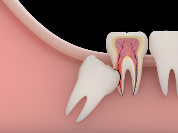 Lý do khiến răng khôn bị mọc lệch