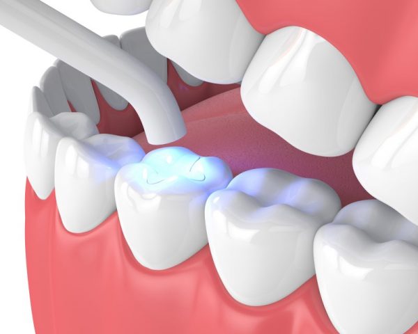 Trám răng thẩm mỹ là gì?