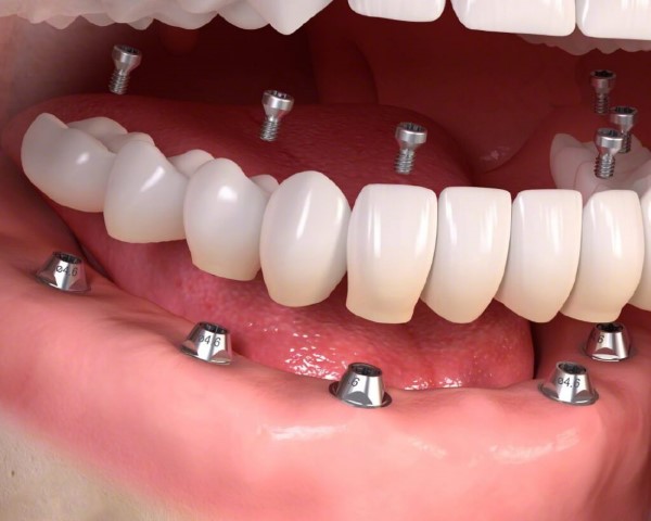 Trồng răng Implant là gì?