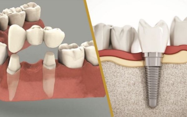 So sánh giữa chi phí làm răng Implant và trồng răng giả