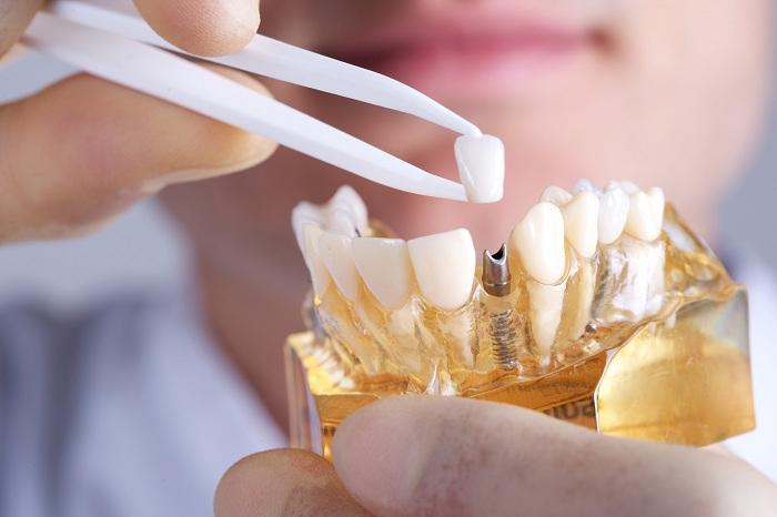 Nha khoa Sài Gòn - Địa chỉ trồng răng Implant Bình Chánh uy tín, chất lượng quốc tế