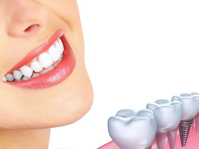 Ưu điểm vượt trội của phương pháp trồng răng Implant