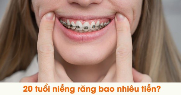 20 Tuổi niềng răng bao nhiêu tiền?