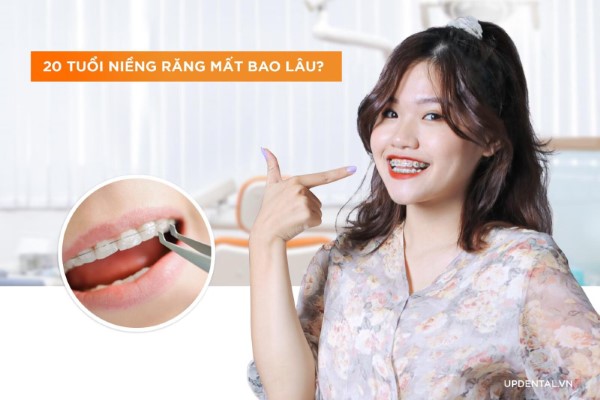 20 Tuổi niềng răng bao lâu?