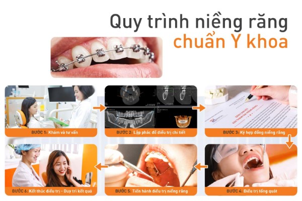 Quy trình niềng răng chuẩn Y khoa tại Nha khoa Sài Gòn