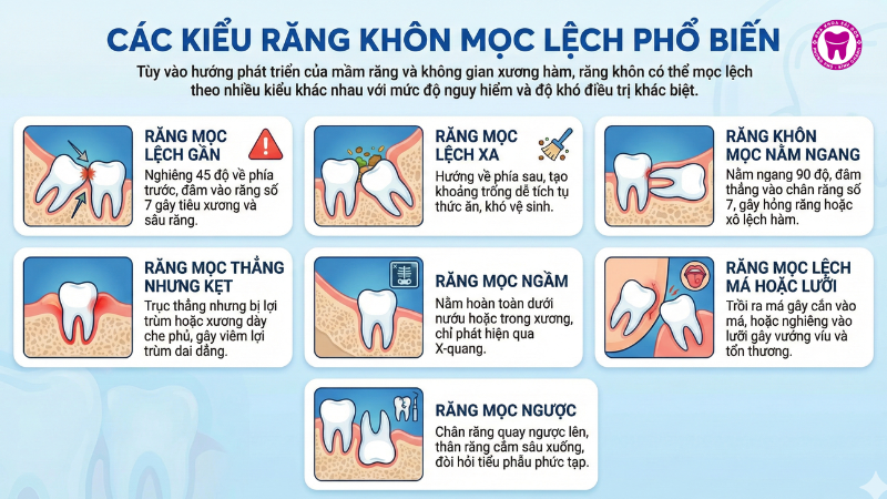Các kiểu răng khôn mọc lệch phổ biến Các kiểu răng khôn mọc lệch phổ biến