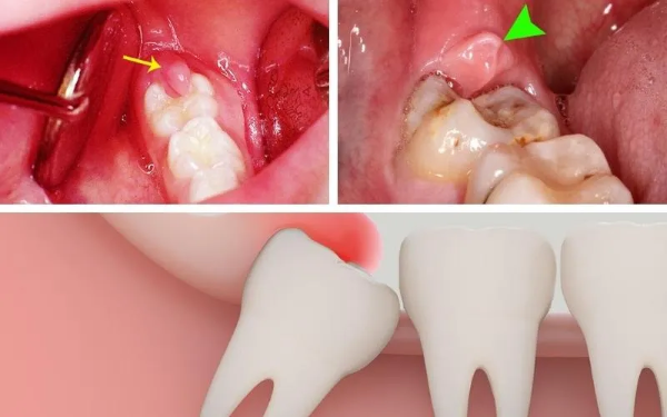 Những lưu ý khi áp dụng cách chữa sưng lợi trong cùng tại nhà