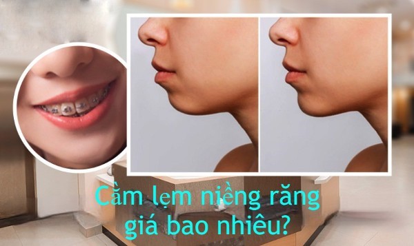 Cằm lẹm niềng răng giá bao nhiêu?