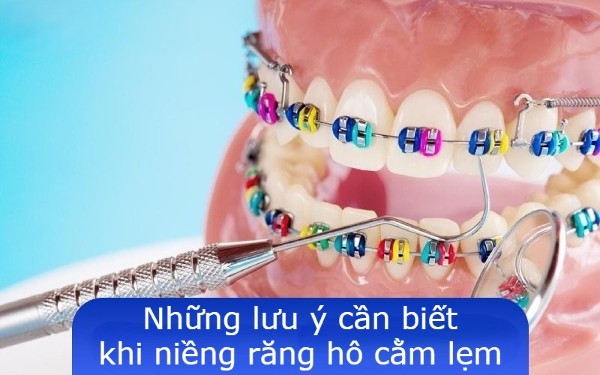 Những lưu ý cần biết khi niềng răng hô cằm lẹm