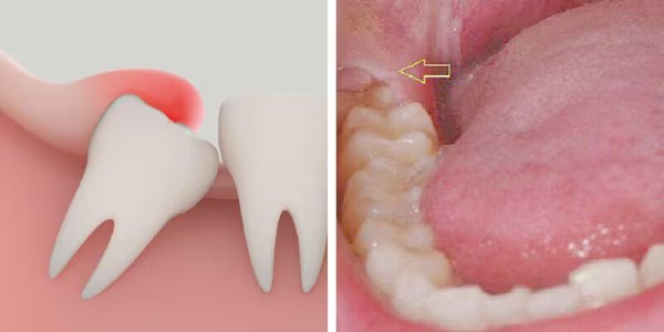 Răng khôn hàm dưới mọc khi nào?
