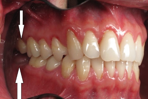 Mọc răng khôn hàm dưới nên làm gì?
