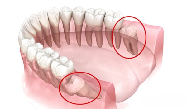 Những biểu hiện mọc răng khôn hàm dưới bất thường cần đi khám ngay