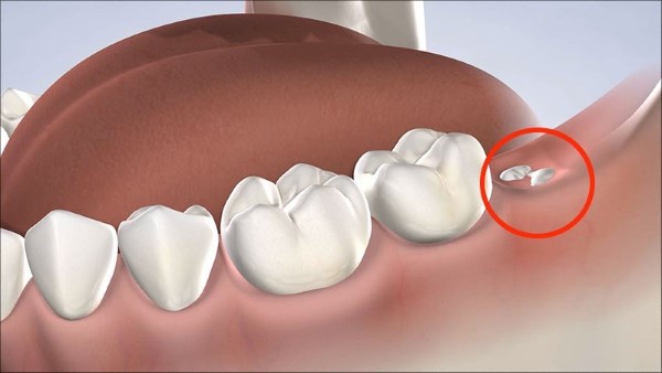 Các dấu hiệu mọc răng khôn hàm dưới