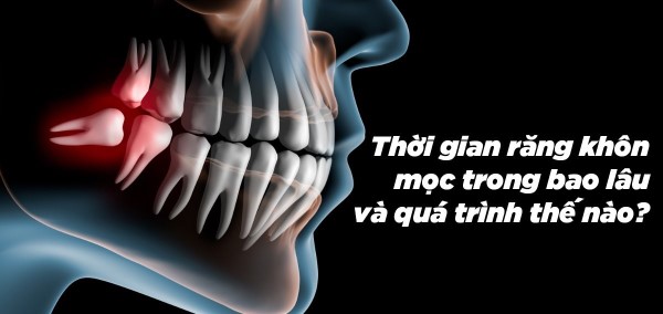 Răng khôn hàm dưới mọc trong bao lâu?