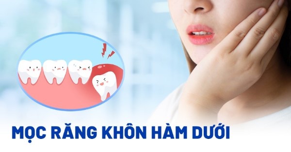 Tại sao mọc răng khôn hàm dưới thường có các triệu chứng khó chịu?