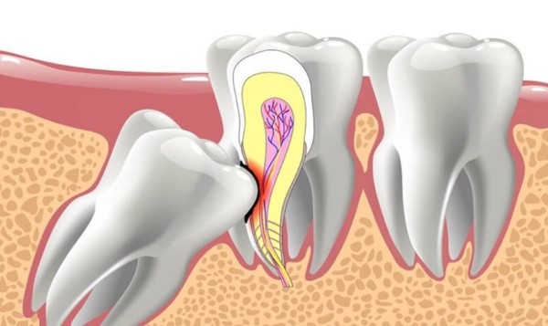 Mọc răng khôn hàm dưới có nguy hiểm không?