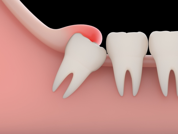 Vì sao mọc răng khôn gây đâu nhức, sứng tấy?