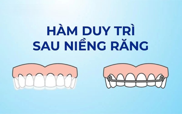 Hàm duy trì sau niềng răng là gì? Có tác dụng gì?