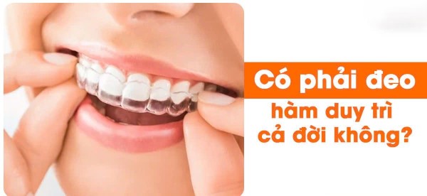 Có phải đeo hàm duy trì cả đời không?