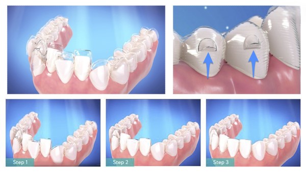 Cách để rút ngắn thời gian niềng răng trong suốt