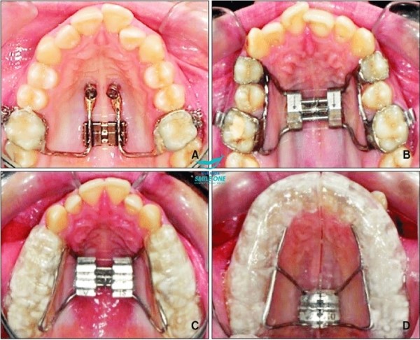 Những phương pháp nong hàm phổ biến hiện nay