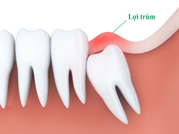 Gây ra tình trạng viêm lợi trùm răng khôn