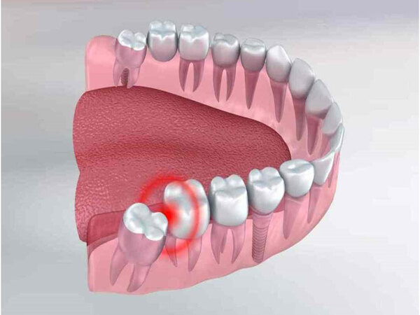 Mức độ nguy hiểm của răng khôn nếu không điều trị kịp thời