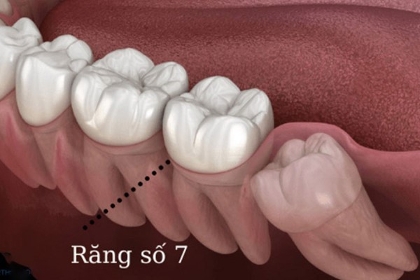 Răng số 7 là răng nào?