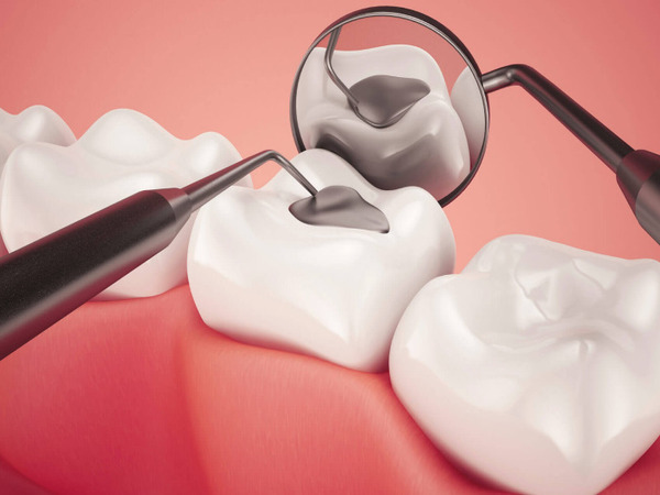 Giới thiệu về phương pháp trám răng