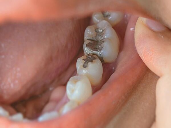 Cơ thể bắt đầu phản ứng với chất trám