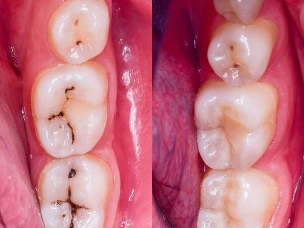 Những trường hợp nào nên trám răng?