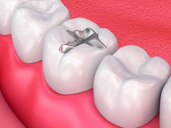 Độ bền trám răng phụ thuộc vào những yếu tố nào?