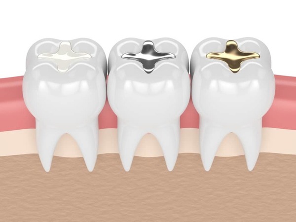Lựa chọn vật liệu trám răng chất lượng tốt