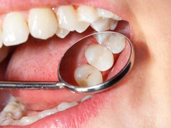 Sau khi trám răng bao lâu mới cần phải trám lại?