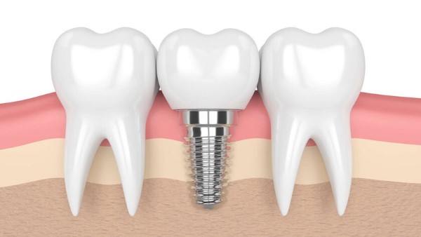 Trồng răng số 7 nên chọn phương pháp nào?