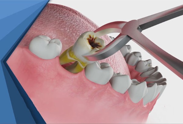 Răng số 7 có cần nhổ không?