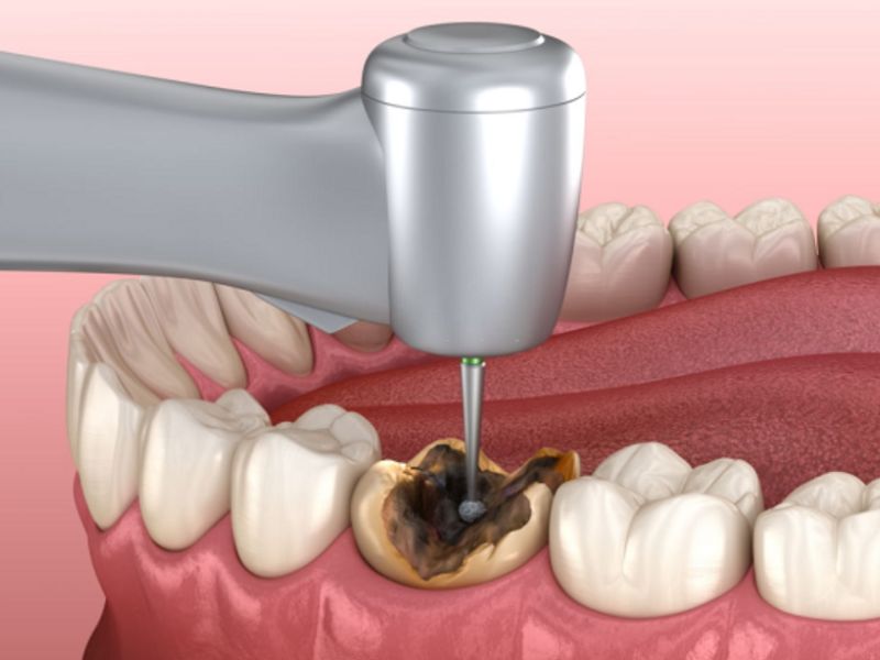 Quy trình trám răng an toàn và hiệu quả